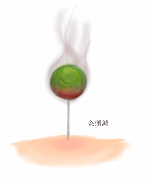 更年期障害と鍼灸
